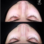 Resultados de rinoplastia antes y después en Medipol Acibadem District Hospital, remodelación nasal