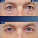 Before and after upper and lower eyelid surgery results at Asia Cosmetic Hospital
