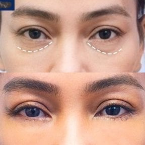 Before and after upper and lower eyelid surgery results at Asia Cosmetic Hospital
