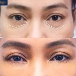 Before and after upper and lower eyelid surgery results at Asia Cosmetic Hospital