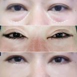 Upper and lower eyelid surgery before and after results at Asia Cosmetic Hospital, rejuvenated look