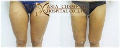 Before and after liposuction results at Asia Cosmetic Hospital, slimmer thighs contour visible