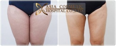 Before and after liposuction results at Asia Cosmetic Hospital, slimmer thighs contour achieved