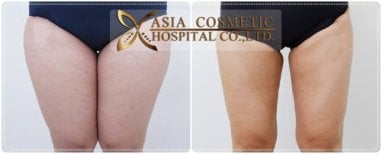Before and after liposuction results at Asia Cosmetic Hospital, slimmer thighs contour achieved