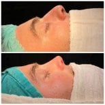 Vorher-nachher-Rhinoplastik-Ergebnis bei Liv Hospital Vadistanbul, verbesserte Nasenform