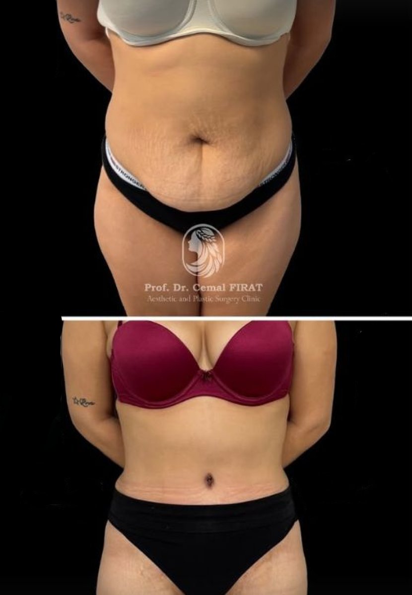 Resultados de abdominoplastia antes y después en Medical Park Antalya Hospital Complex, abdomen plano