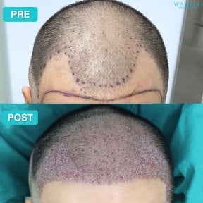 Before and after PRP hair loss treatment results at Wansiri Hospital, improved hair density