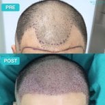 Before and after PRP hair loss treatment results at Wansiri Hospital, improved hair density