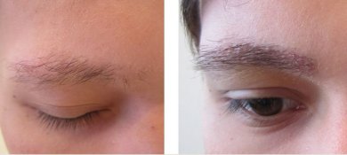 Vorher-nachher-Ergebnis der Augenbrauentransplantation bei Adem and Havva Medical Center, dichtere Brauen