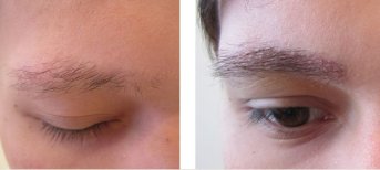 Vorher-nachher-Ergebnis der Augenbrauentransplantation bei Adem and Havva Medical Center, dichtere Brauen