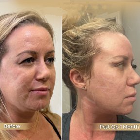 Vorher-nachher-Ergebnis endoskopisches Facelifting bei Dr. Safa Manav Clinic