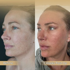 Vorher-nachher-Ergebnis Endoskopisches Facelifting bei Dr. Safa Manav, 7 Wochen post-op