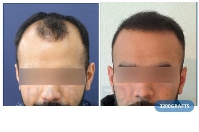 Vorher-nachher-Ergebnis Haartransplantation bei Hairmedico Clinic mit 3200 Grafts