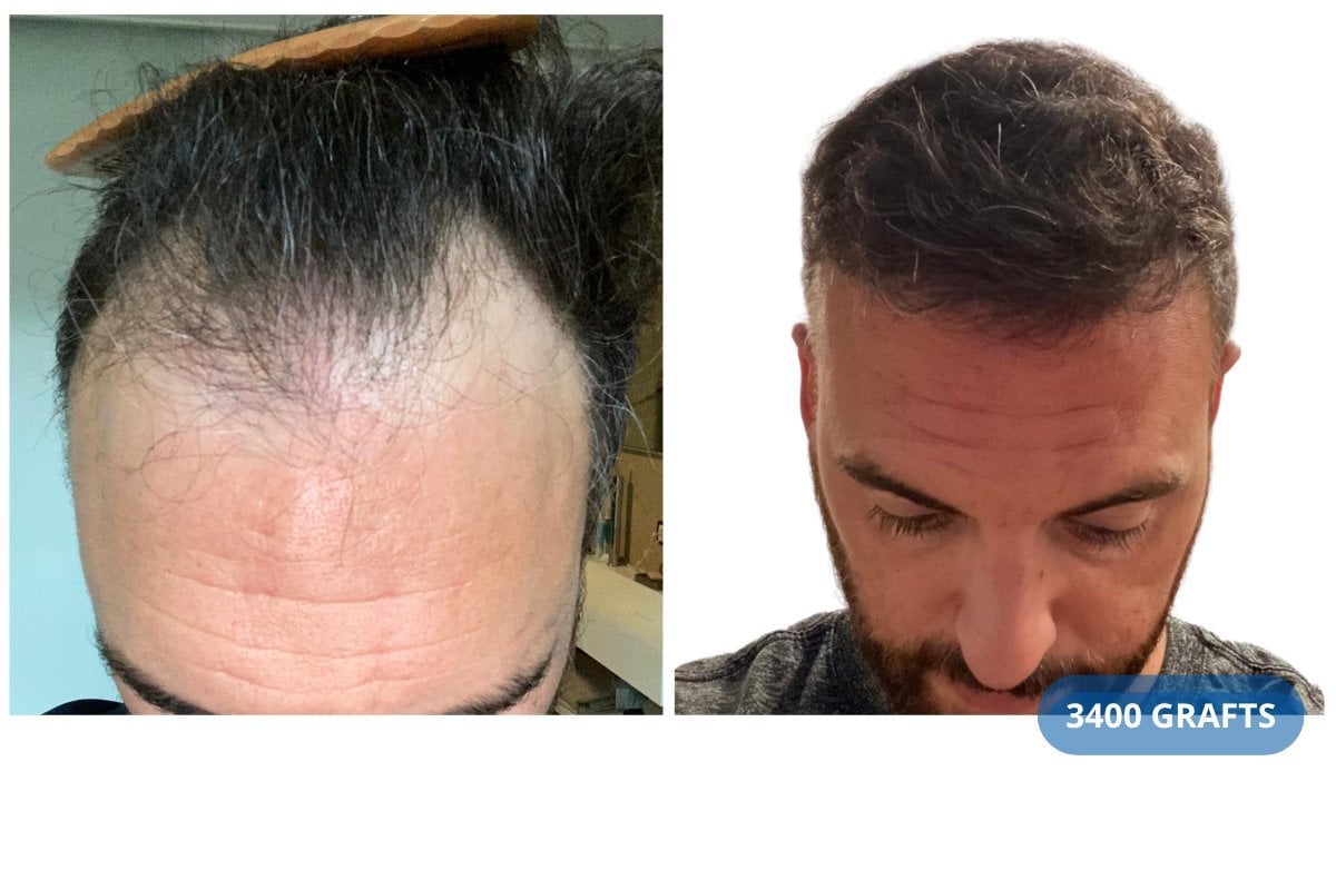 نتيجة زراعة الشعر في عيادة Hairmedico قبل وبعد مع 3400 طعم، خط شعر أكثر كثافة