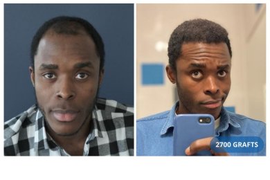 Vorher-nachher-Ergebnis einer 2700-Grafts-Haartransplantation bei Hairmedico Clinic