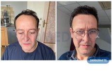 Vorher-nachher-Ergebnis: 2800 Grafts Haartransplantation bei Hairmedico Clinic, Haaransatz