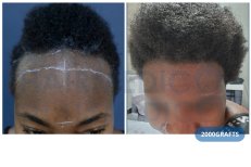Vorher-nachher-Ergebnis Haartransplantation bei Hairmedico Clinic mit 2000 Grafts am Haaransatz
