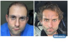 Ergebnis Haartransplantation mit 2000 Grafts bei Hairmedico Clinic, vollere Haarlinie