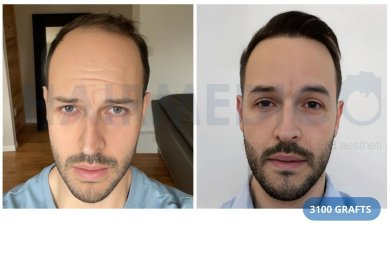 Vorher-nachher-Ergebnis: 3100 Grafts Haartransplantation bei Hairmedico Clinic