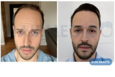Vorher-nachher-Ergebnis: 3100 Grafts Haartransplantation bei Hairmedico Clinic