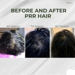Résultats du traitement PRP contre la perte de cheveux chez Plenary Wellness – densité accrue