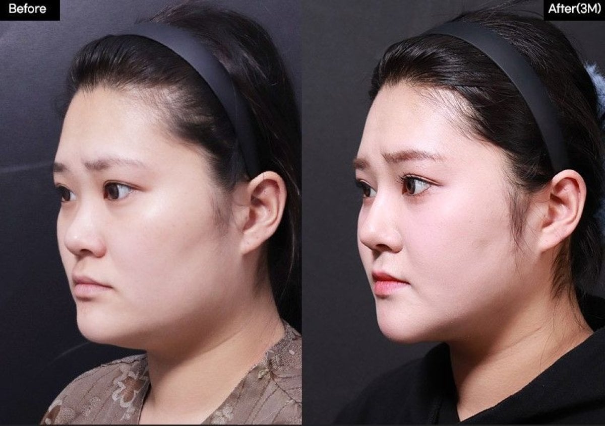 قبل وبعد زراعة الخدود في VG Plastic Surgery، نتيجة تحسين ملامح الخد واضحة