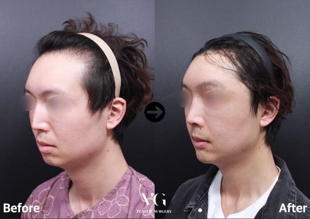 قبل وبعد زراعة الخدود في VG Plastic Surgery، نتائج تحسين ملامح الوجه