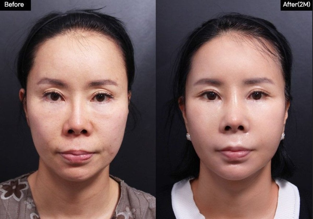 قبل وبعد زراعة الخدود في VG Plastic Surgery، نتيجة تحسين حجم وتحديد الخدود