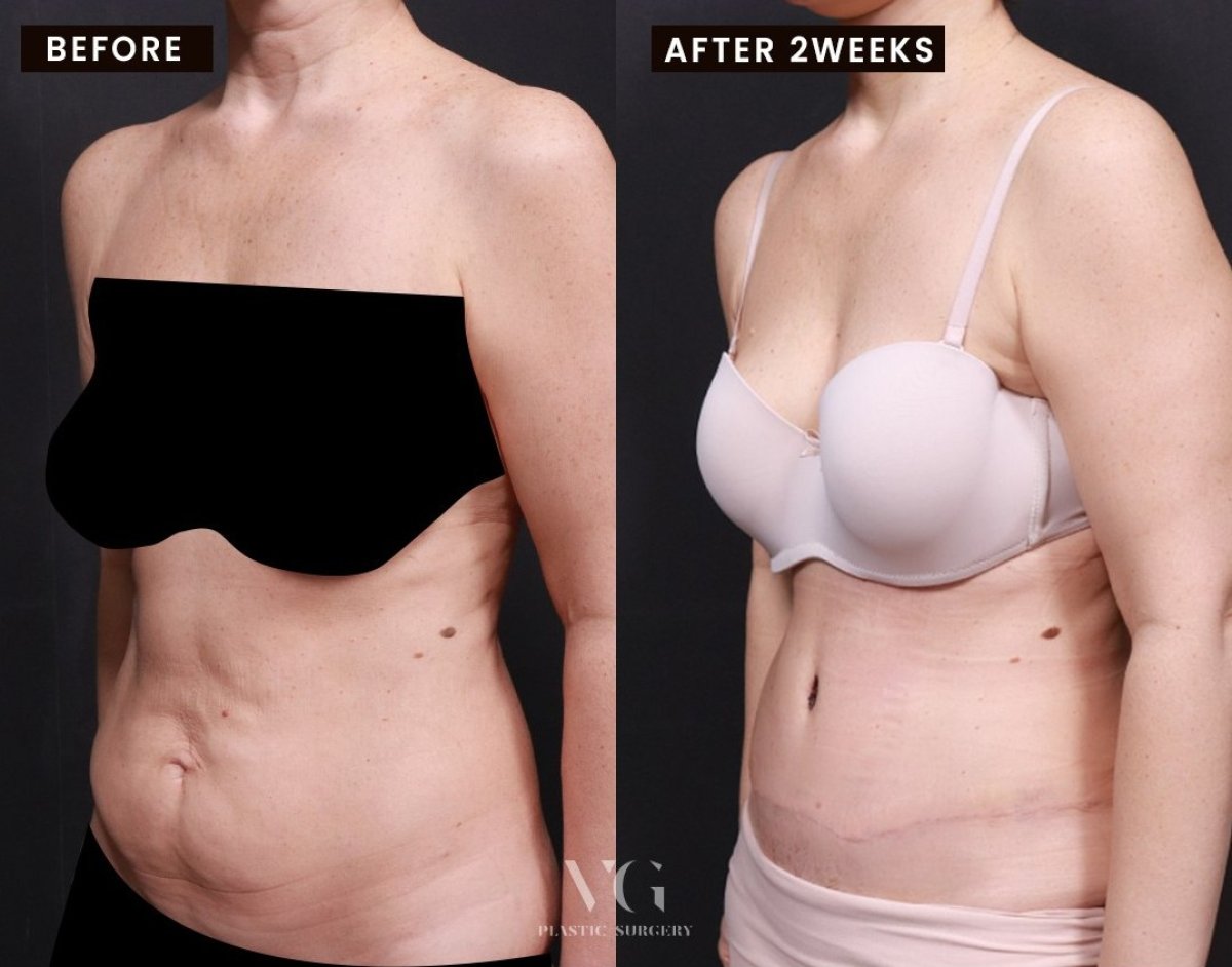 Resultados de abdominoplastia en VG Plastic Surgery: abdomen plano tras 2 semanas