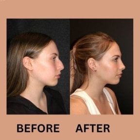Before and after rhinoplasty results at ID Clinic Bangkok, nose reshaping for improved profile