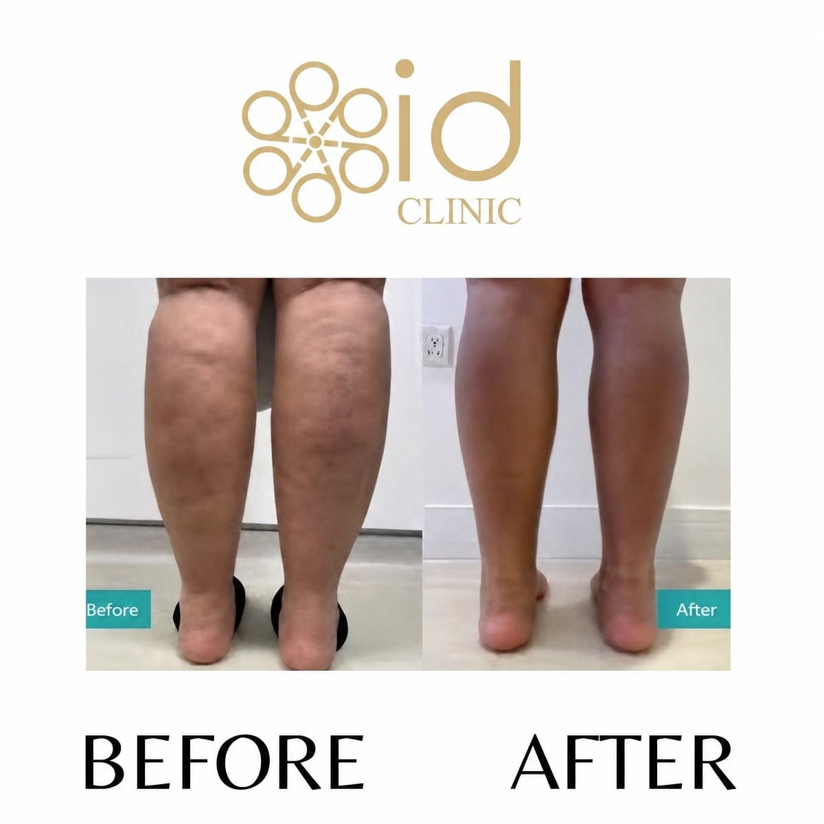 نتائج شفط دهون الساقين قبل وبعد في ID Clinic Bangkok مع مظهر ساقين أنحف