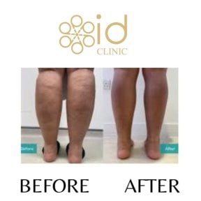 Before and after calf liposuction results at ID Clinic Bangkok, slimmer leg contour visible