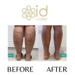 Before and after calf liposuction results at ID Clinic Bangkok, slimmer leg contour visible