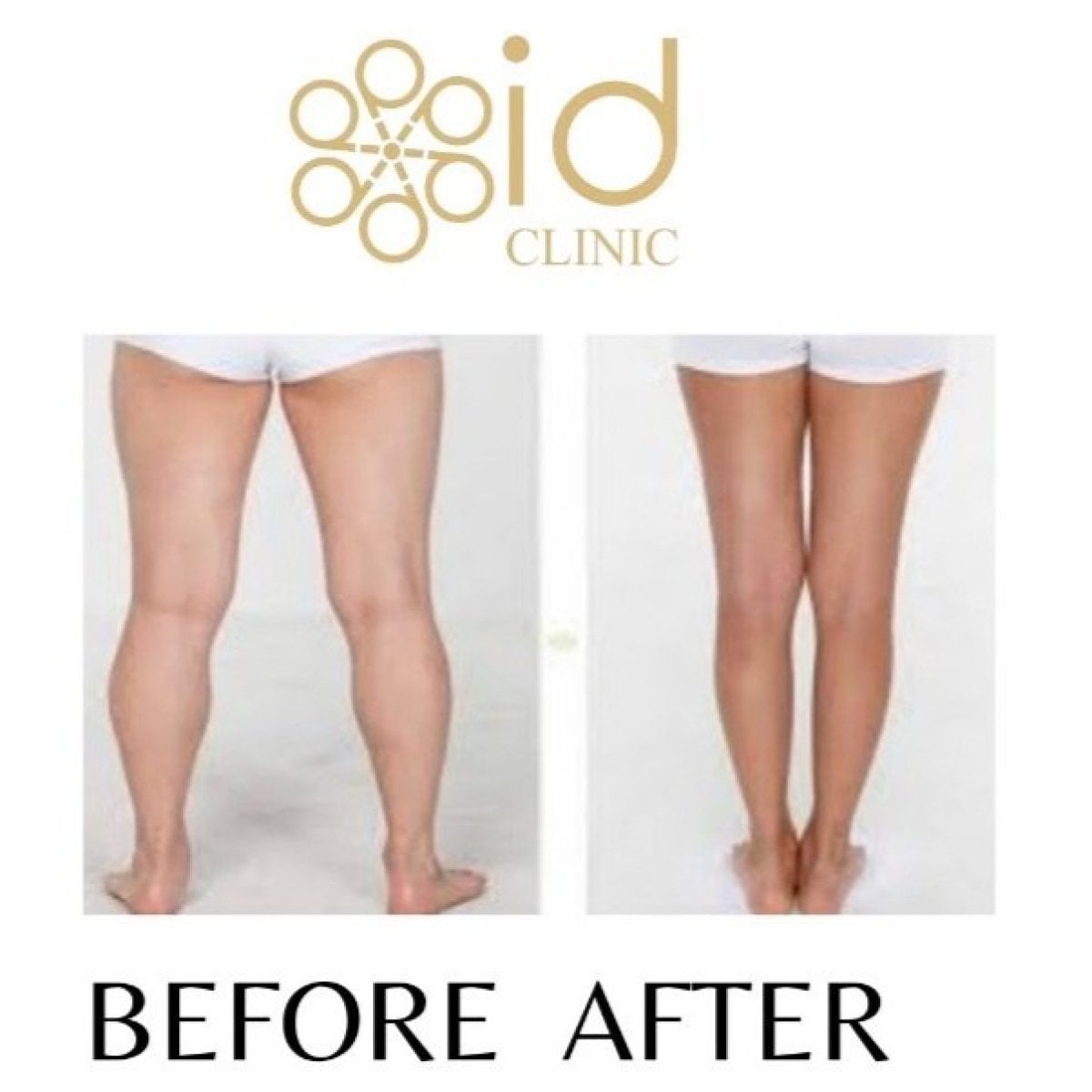 نتائج شفط دهون الساقين قبل وبعد في ID Clinic Bangkok، مظهر أرجل أنحف
