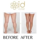 Before and after calf liposuction results at ID Clinic Bangkok, slimmer leg contour visible
