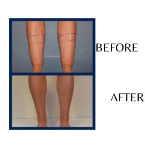 Before and after calf liposuction results at ID Clinic Bangkok, slimmer leg contour achieved