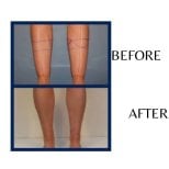 Before and after calf liposuction results at ID Clinic Bangkok, slimmer leg contour achieved