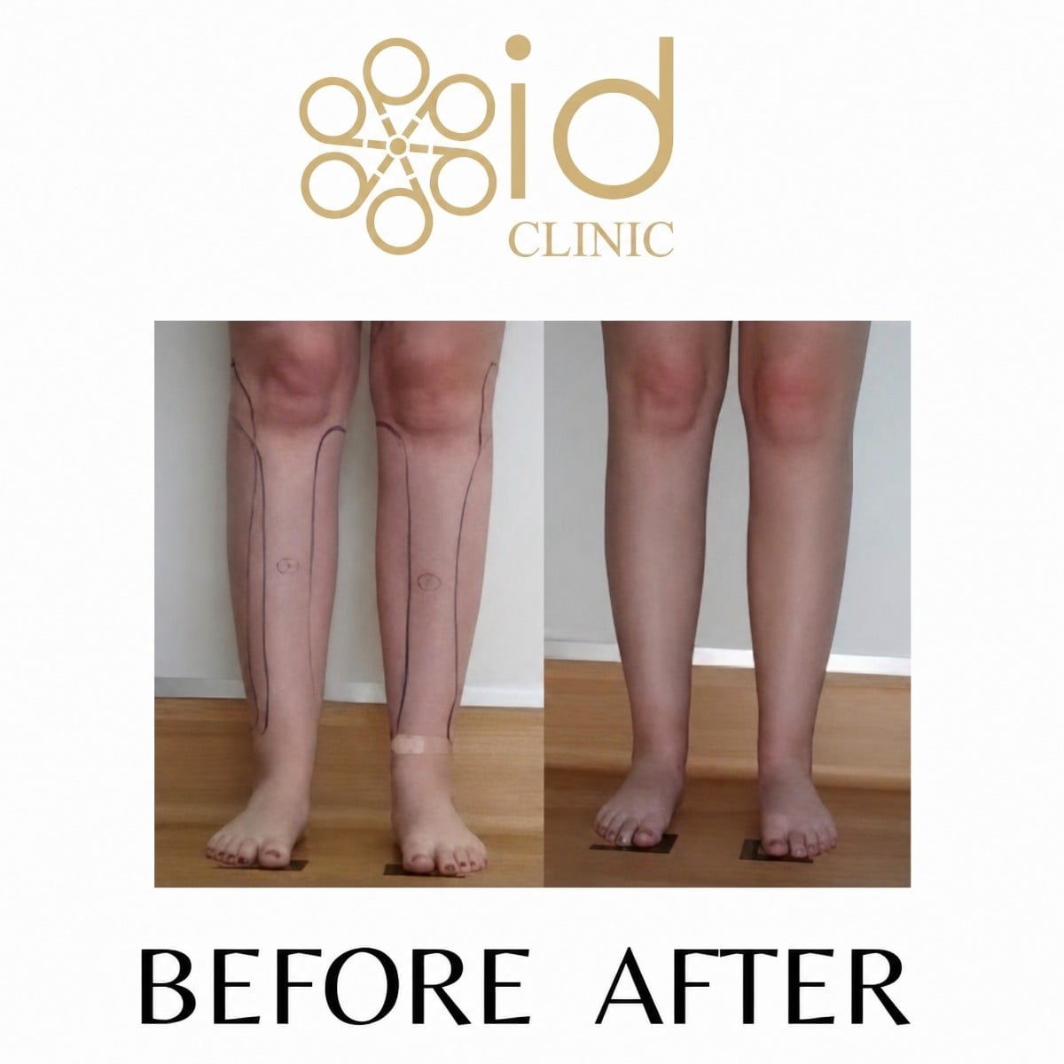 نتائج شفط دهون الساق قبل وبعد في ID Clinic Bangkok – سيقان أنحف ومحددة