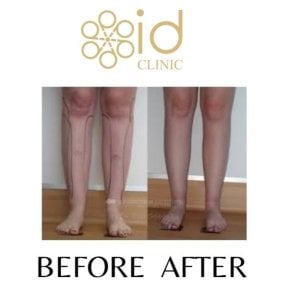 Before and after calf liposuction results at ID Clinic Bangkok – slimmer, contoured legs