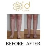Before and after calf liposuction results at ID Clinic Bangkok – slimmer, contoured legs