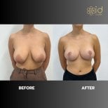 Before and after breast lift results at ID Clinic Bangkok – improved breast shape and contour
