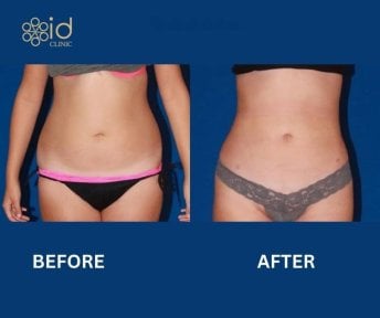 Результаты до и после Vaser липосакции в ID Clinic Bangkok, улучшенный контур талии