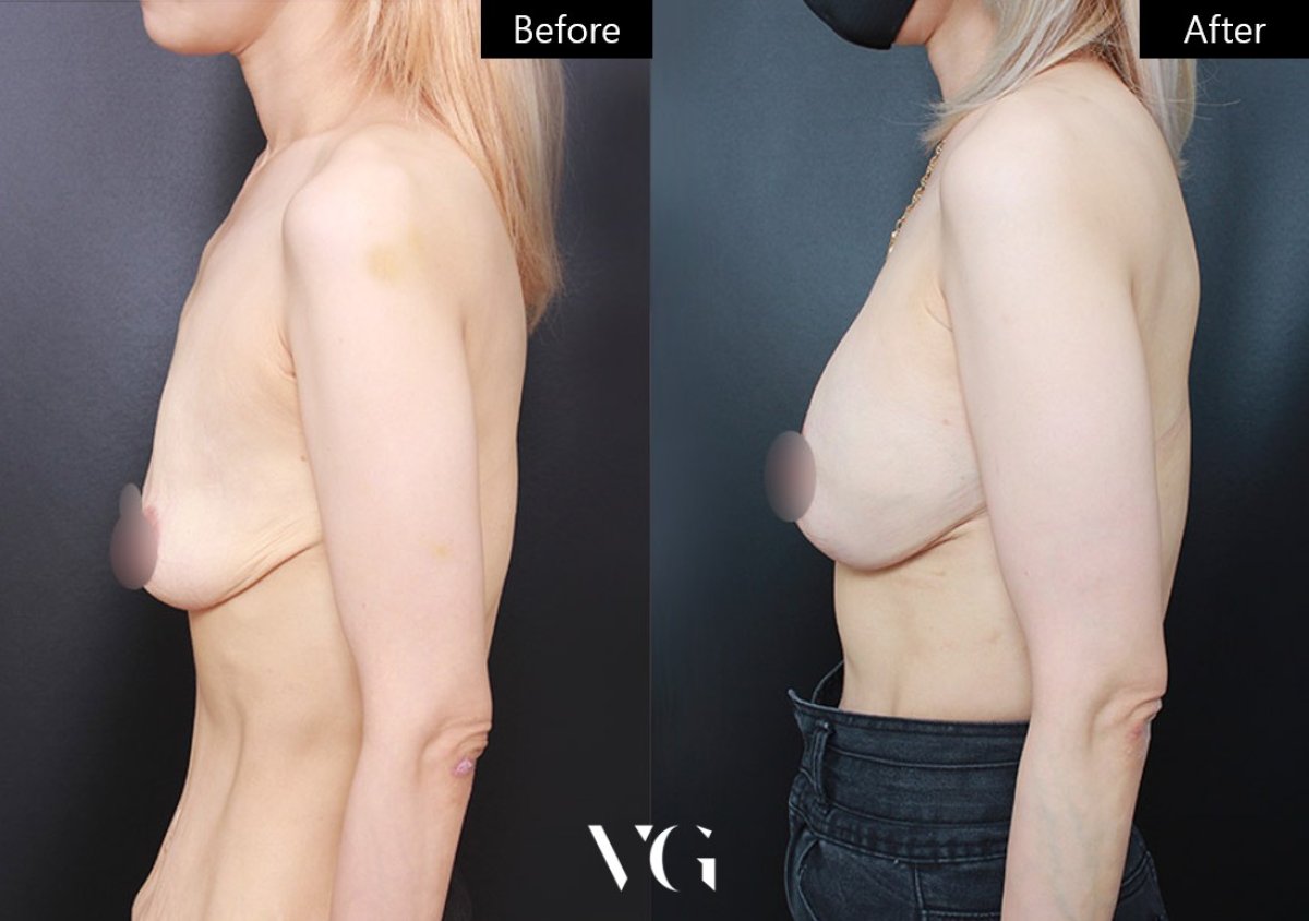 Before and after breast lift results at VG Plastic Surgery – improved breast contour visible