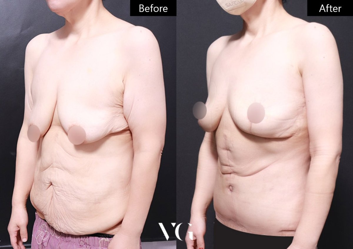Before and after breast lift results at VG Plastic Surgery, improved breast contour and firmness