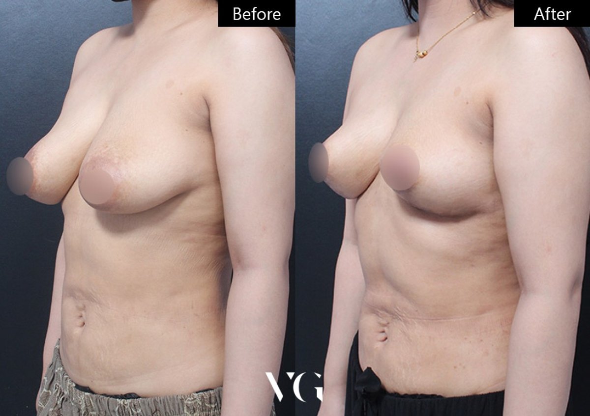 Before and after breast lift results at VG Plastic Surgery, visible breast contour improvement