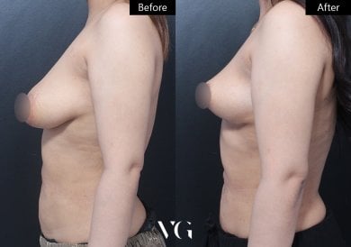 Efekty przed i po liftingu piersi w VG Plastic Surgery – poprawiony kształt biustu