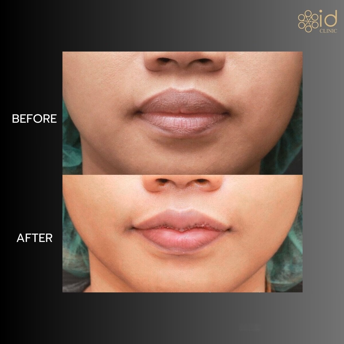 نتائج تصغير الشفاه قبل وبعد في ID Clinic Bangkok، شفاه أنحف بشكل واضح