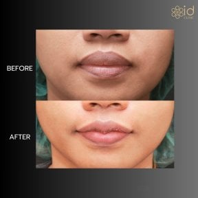 Before and after lip reduction results at ID Clinic Bangkok, visible slimmer lips outcome