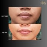 Before and after lip reduction results at ID Clinic Bangkok, visible slimmer lips outcome