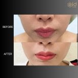 Before and after lip reduction at ID Clinic Bangkok, visible lip contour improvement result